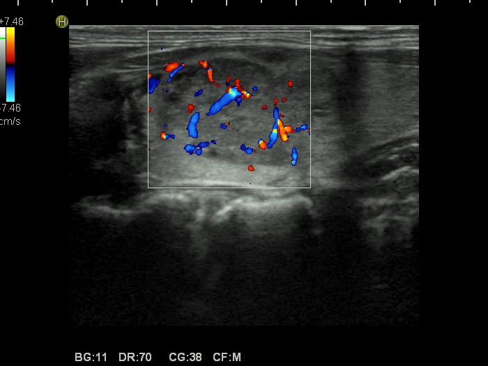 Right lobe, longitudinal scan