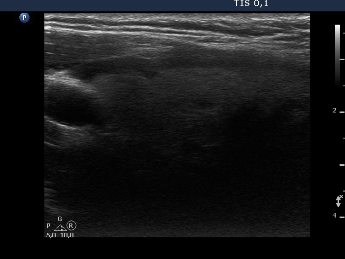 Right lobe, longitudinal scan