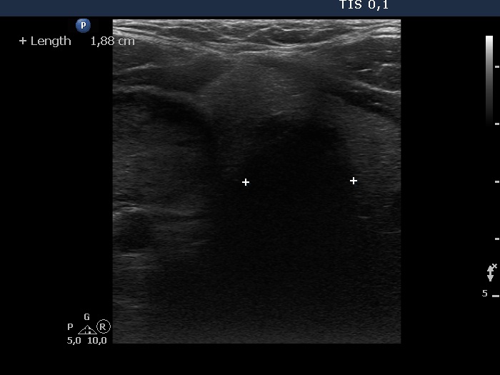 Right lobe, longitudinal scan