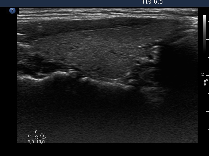 Right lobe, longitudinal scan