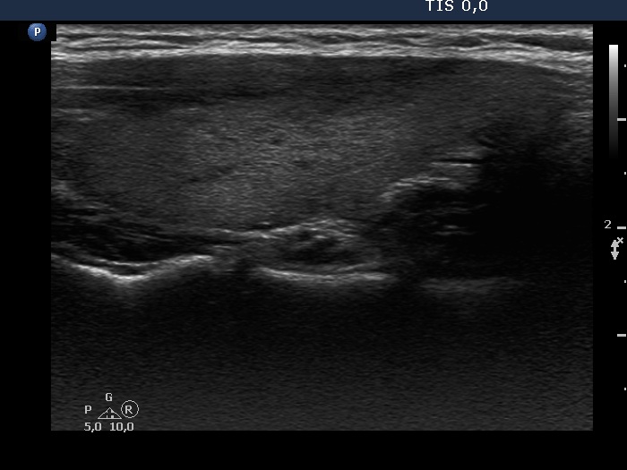 Right lobe, longitudinal scan