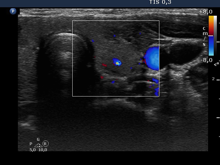 Right lobe, longitudinal scan