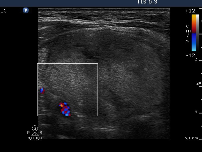 Right lobe, longitudinal scan