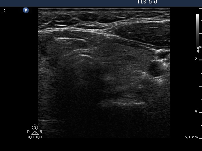Right lobe, longitudinal scan