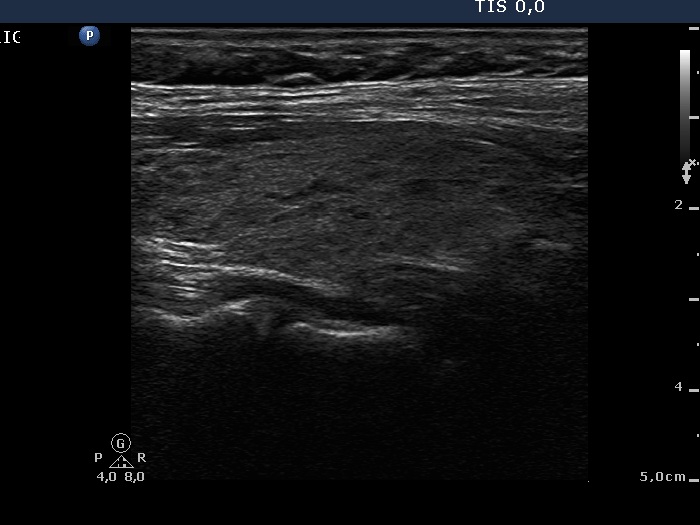 Right lobe, longitudinal scan