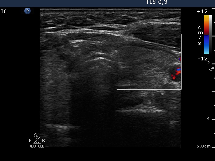 Right lobe, longitudinal scan