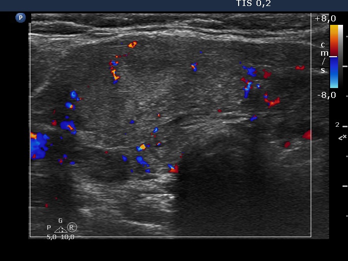 Right lobe, longitudinal scan