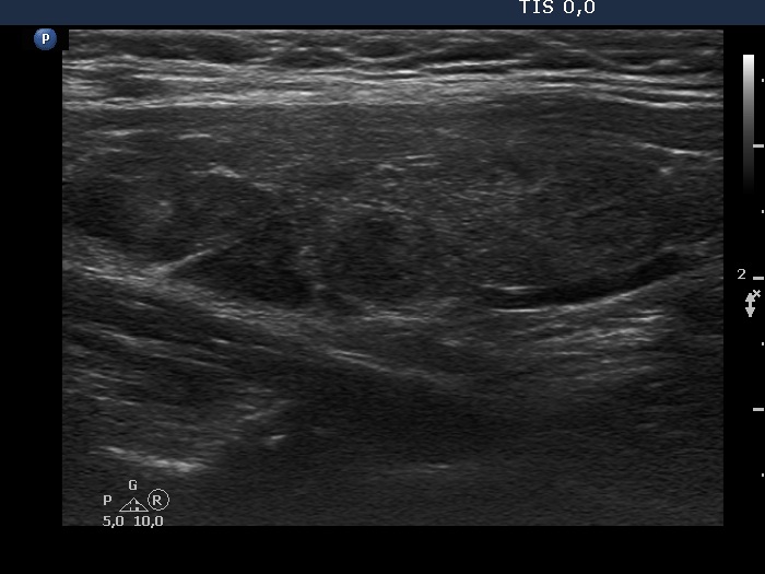 Right lobe, longitudinal scan