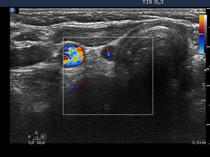 Right lobe, longitudinal scan