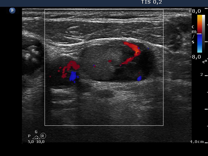 Right lobe, longitudinal scan