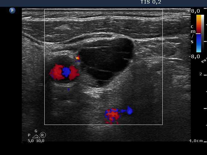 Right lobe, longitudinal scan