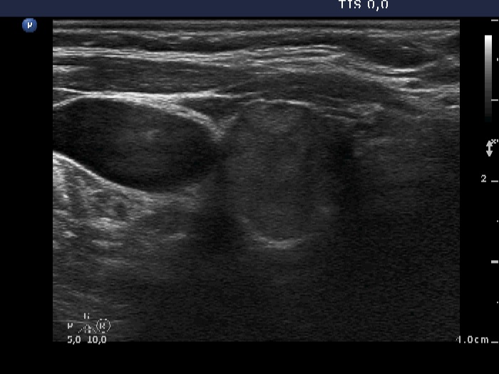 Right lobe, longitudinal scan