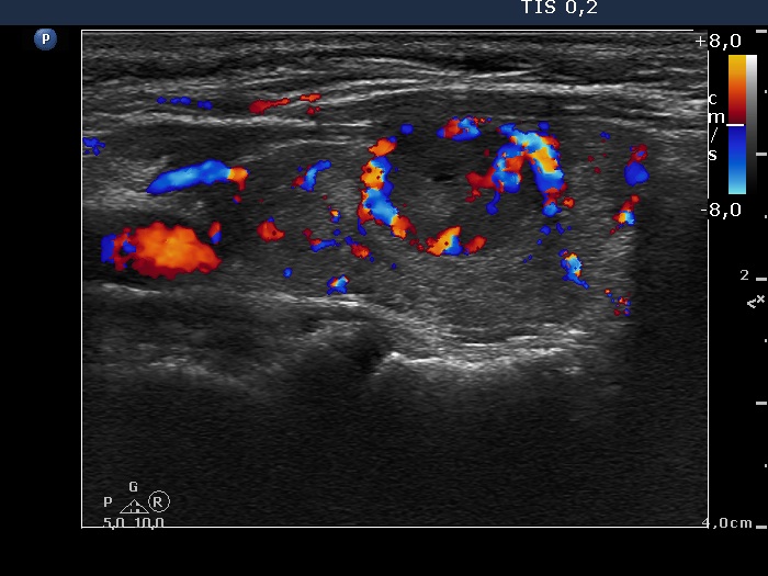 Right lobe, longitudinal scan