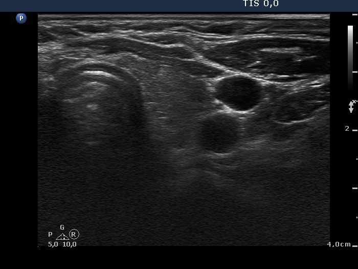 Right lobe, longitudinal scan