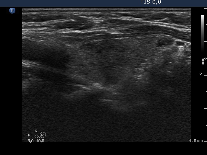 Right lobe, longitudinal scan