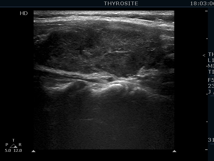 Right lobe, longitudinal scan