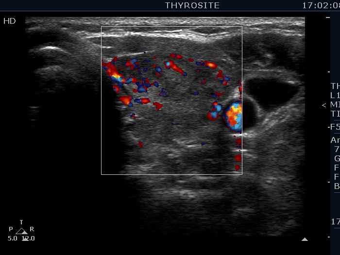 Right lobe, longitudinal scan