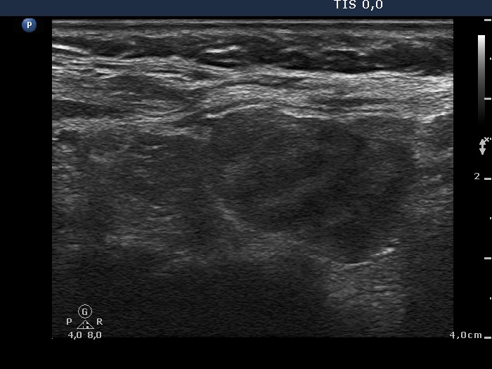 Right lobe, longitudinal scan