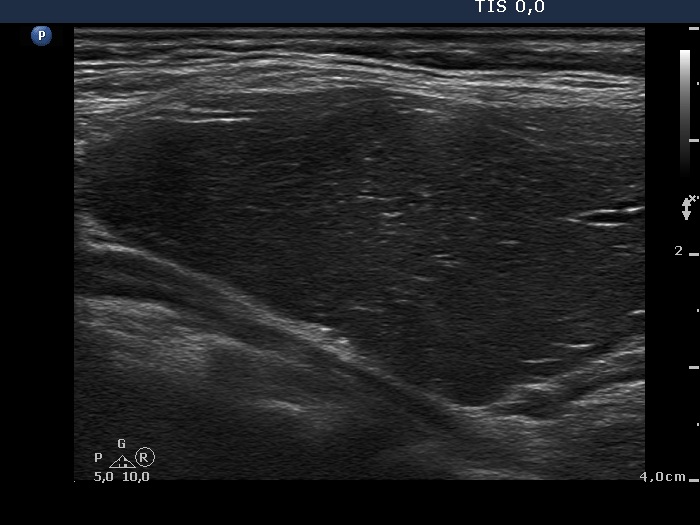 Right lobe, longitudinal scan