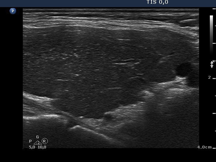 Right lobe, longitudinal scan