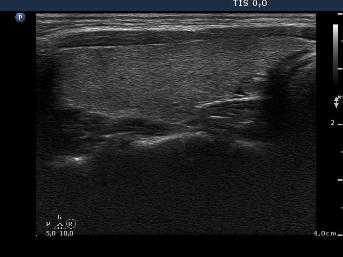 Right lobe, longitudinal scan