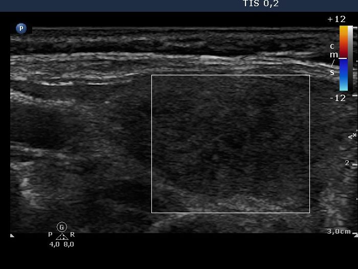 Right lobe, longitudinal scan