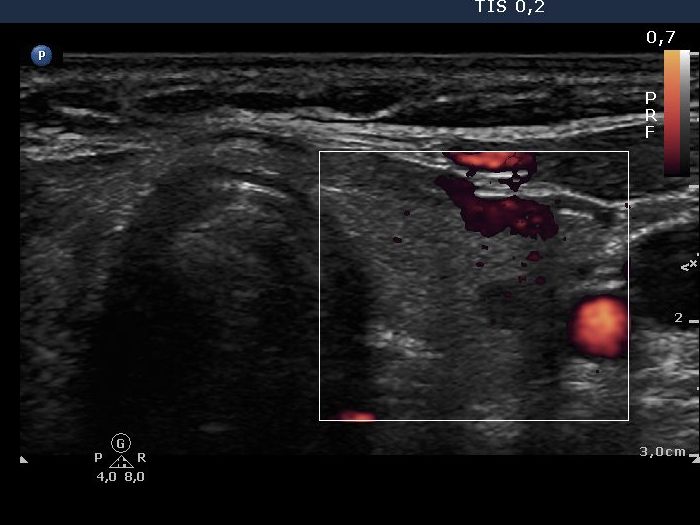 Right lobe, longitudinal scan