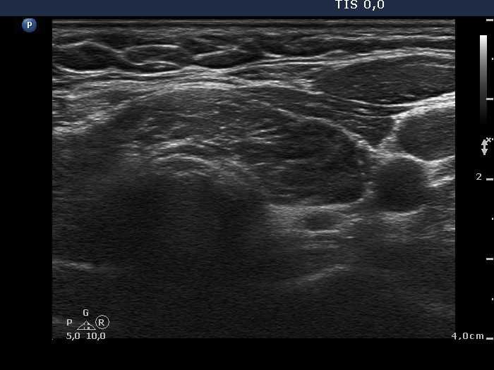 Right lobe, longitudinal scan