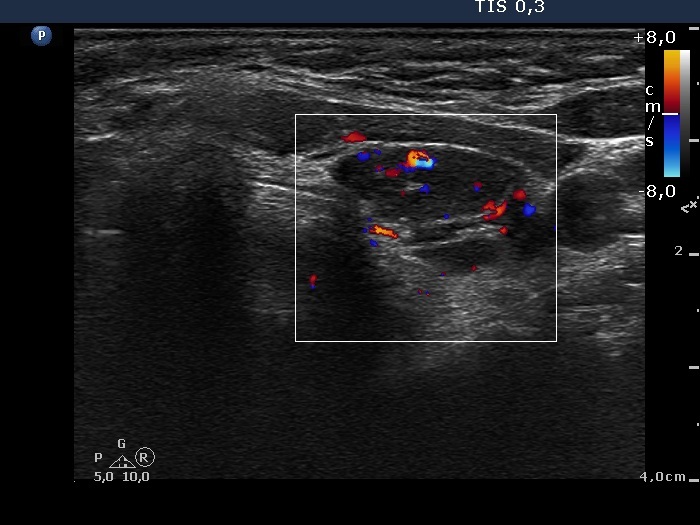 Right lobe, longitudinal scan