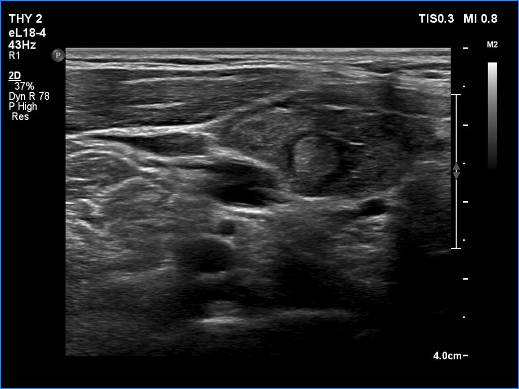 Right lobe, longitudinal scan