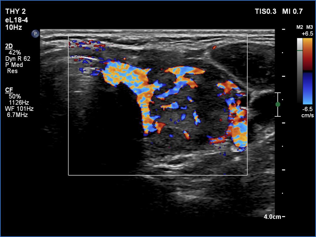 Right lobe, longitudinal scan