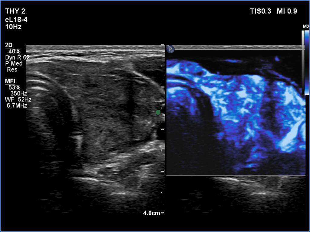 Right lobe, longitudinal scan
