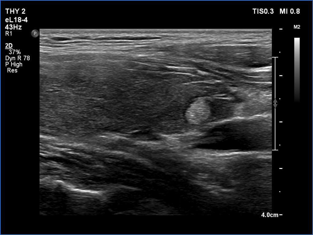 Right lobe, longitudinal scan