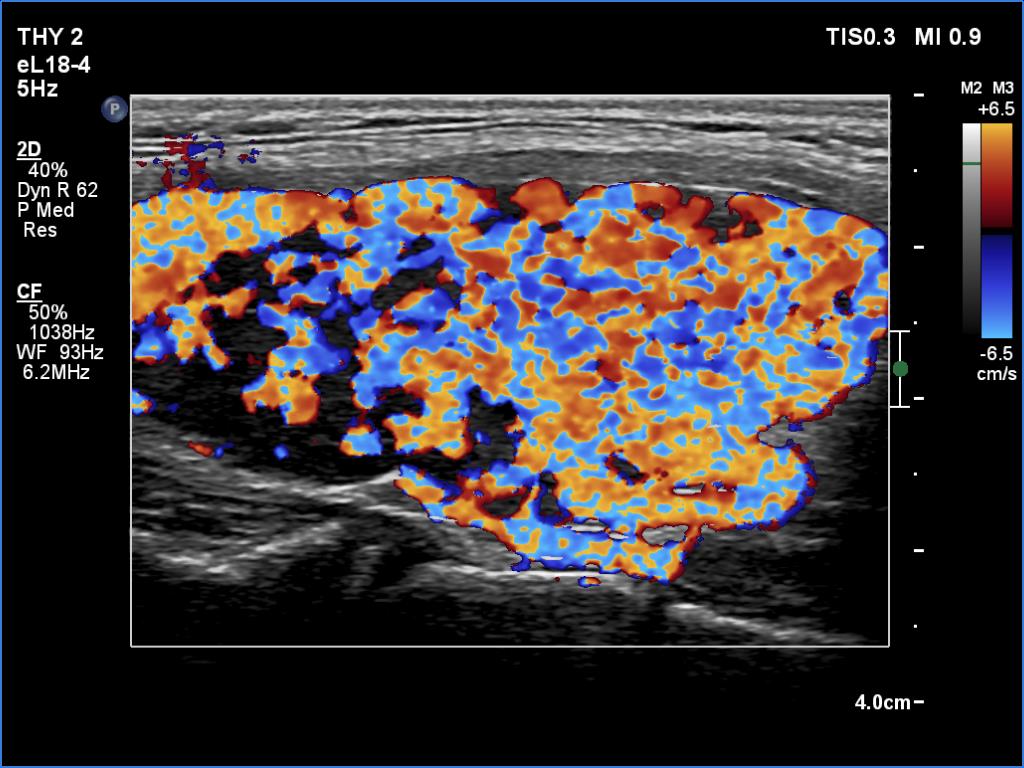 Right lobe, longitudinal scan
