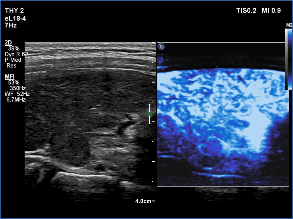 Right lobe, longitudinal scan