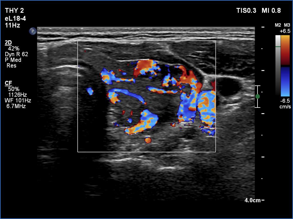 Right lobe, longitudinal scan