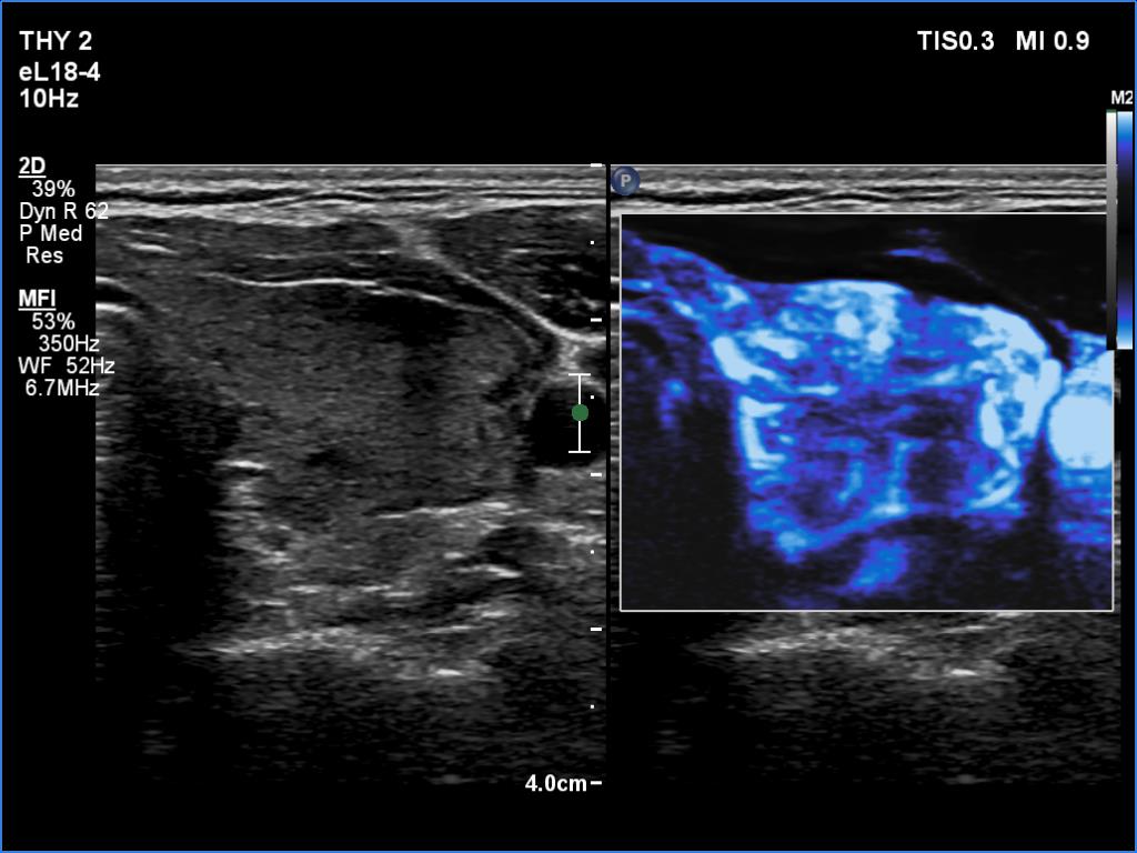 Right lobe, longitudinal scan