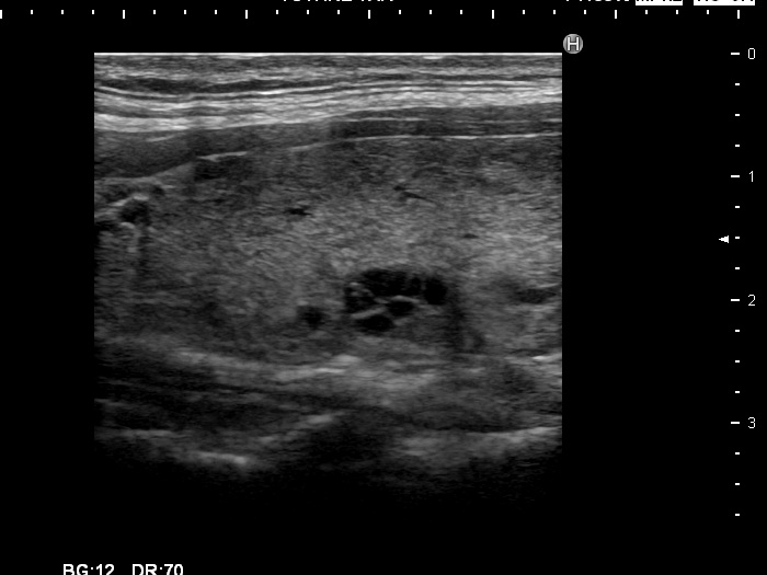 Right lobe, longitudinal scan