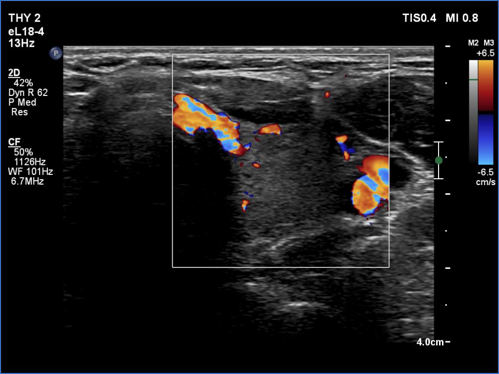 Right lobe, longitudinal scan