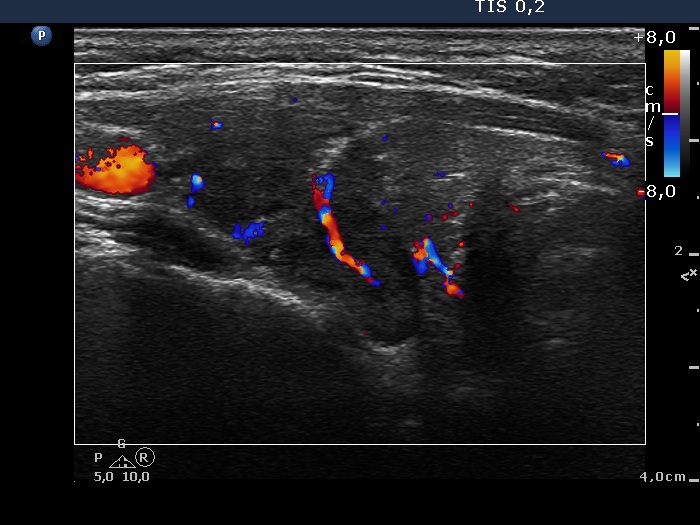 Right lobe, longitudinal scan
