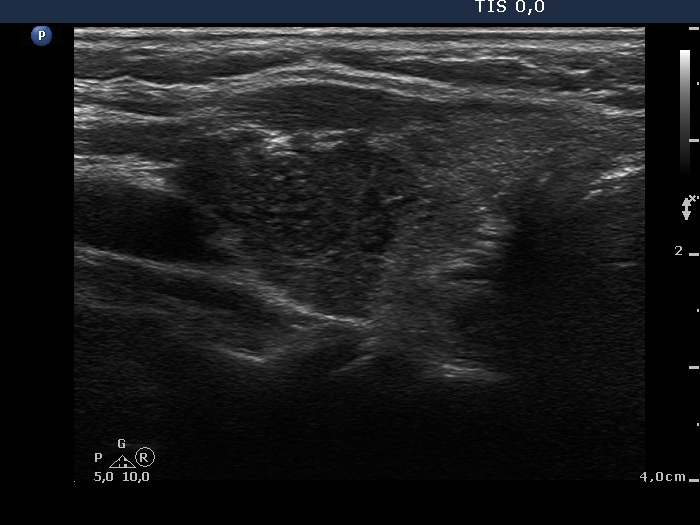 Right lobe, longitudinal scan