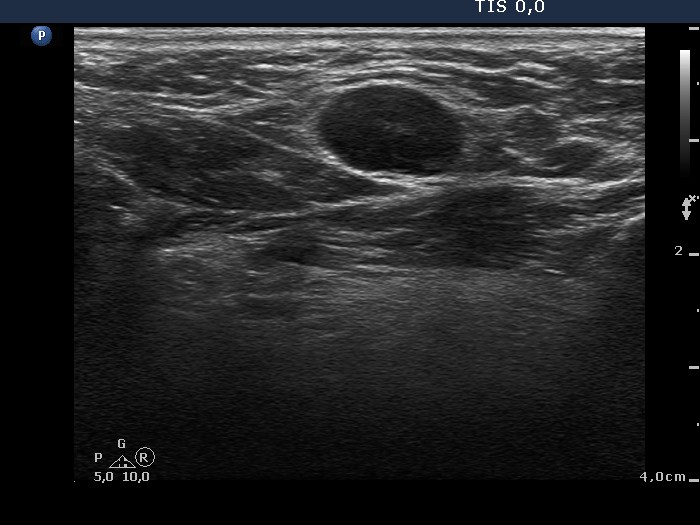 Right lobe, longitudinal scan