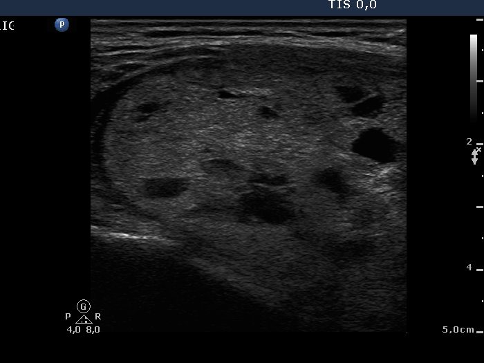 Right lobe, longitudinal scan