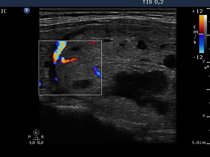 Right lobe, longitudinal scan
