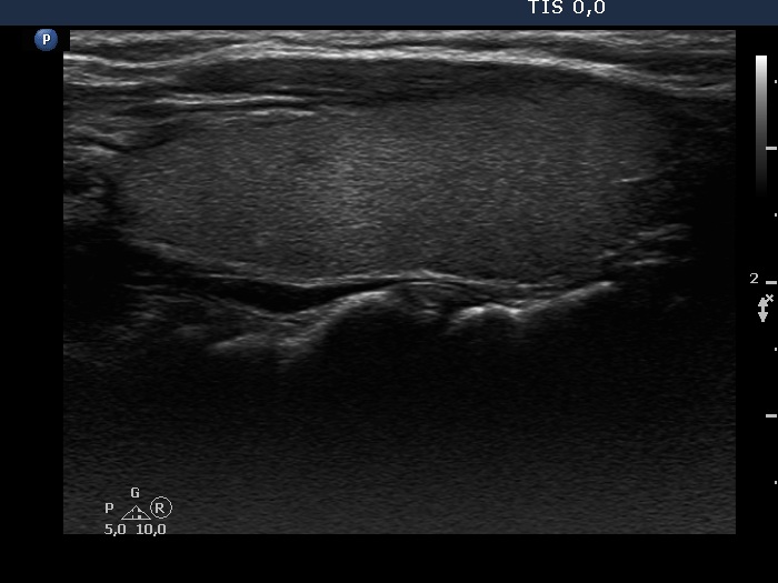 Right lobe, longitudinal scan