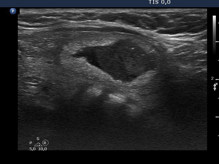 Right lobe, longitudinal scan