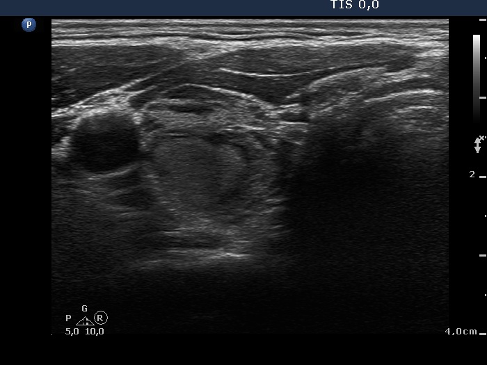 Right lobe, longitudinal scan