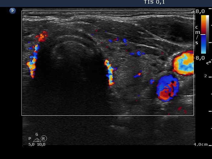 Right lobe, longitudinal scan