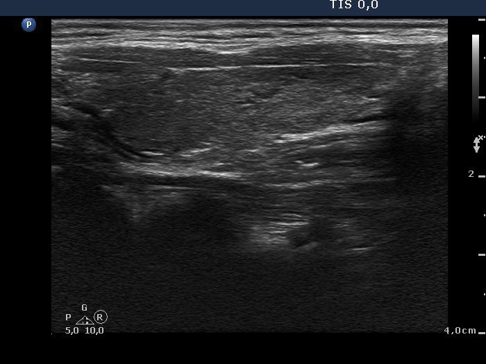 Right lobe, longitudinal scan