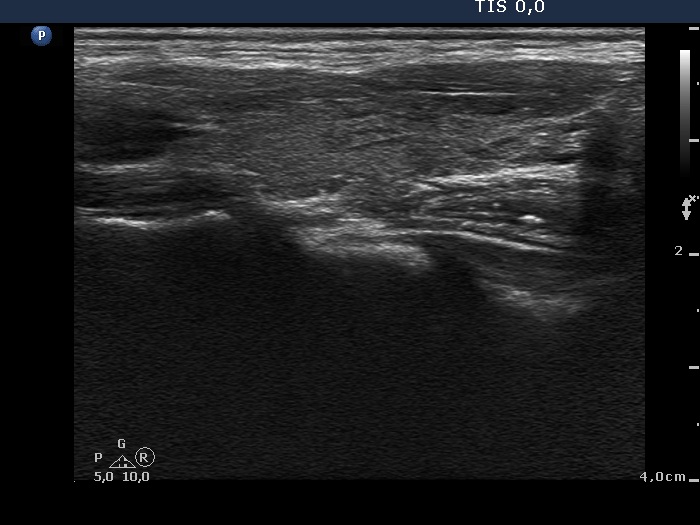 Right lobe, longitudinal scan